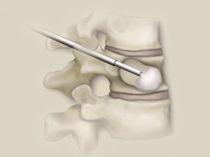 Kyphoplasty