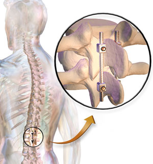 lumbar-fusion